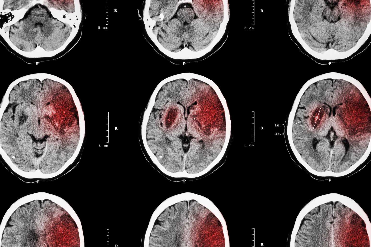 Ischemic stroke